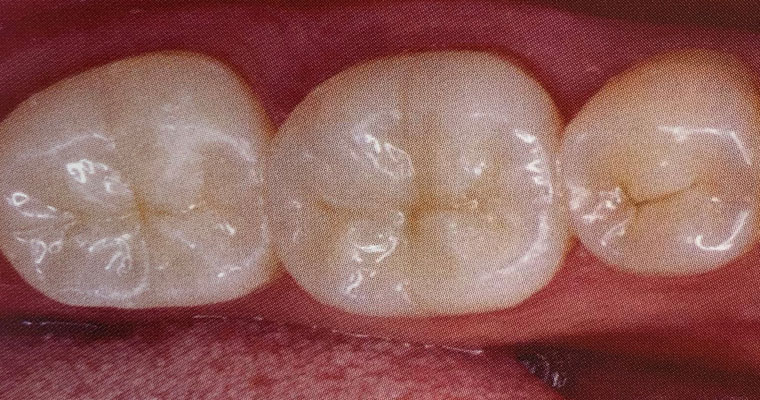 Cosmetic Fillings